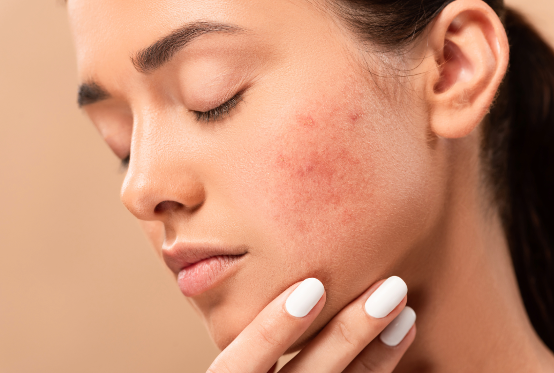 Why Inflammation Shows Up on Your Skin, and How to Keep It in Check