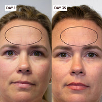 Before and after comparison of a woman's face with a focus on forehead area, showing improvement over 35 days.