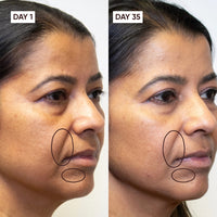 Before and after comparison of a woman's face with marked areas on Day 1 and Day 35.