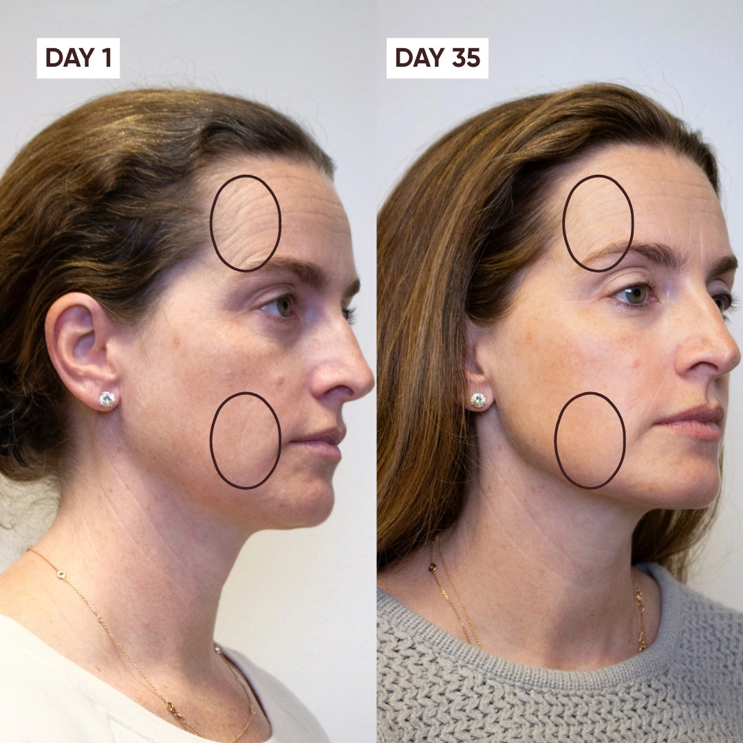 Side-by-side comparison of a woman's face on Day 1 and Day 35 with marked areas.